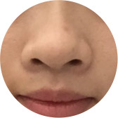 蒜头鼻