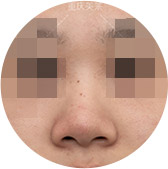 鼻头大
