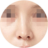 歪鼻