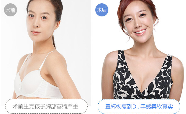 美莱自体脂肪丰胸对比图