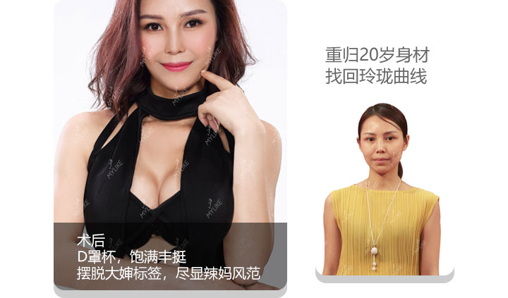 美莱丰胸案例—杨旸