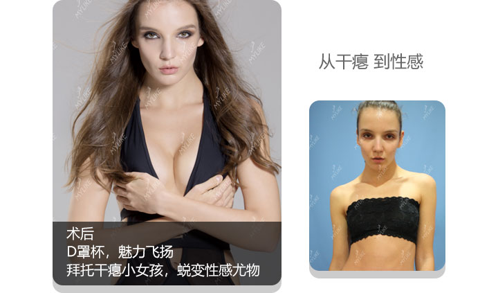 美莱丰胸案例—米查