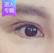 双眼皮修复